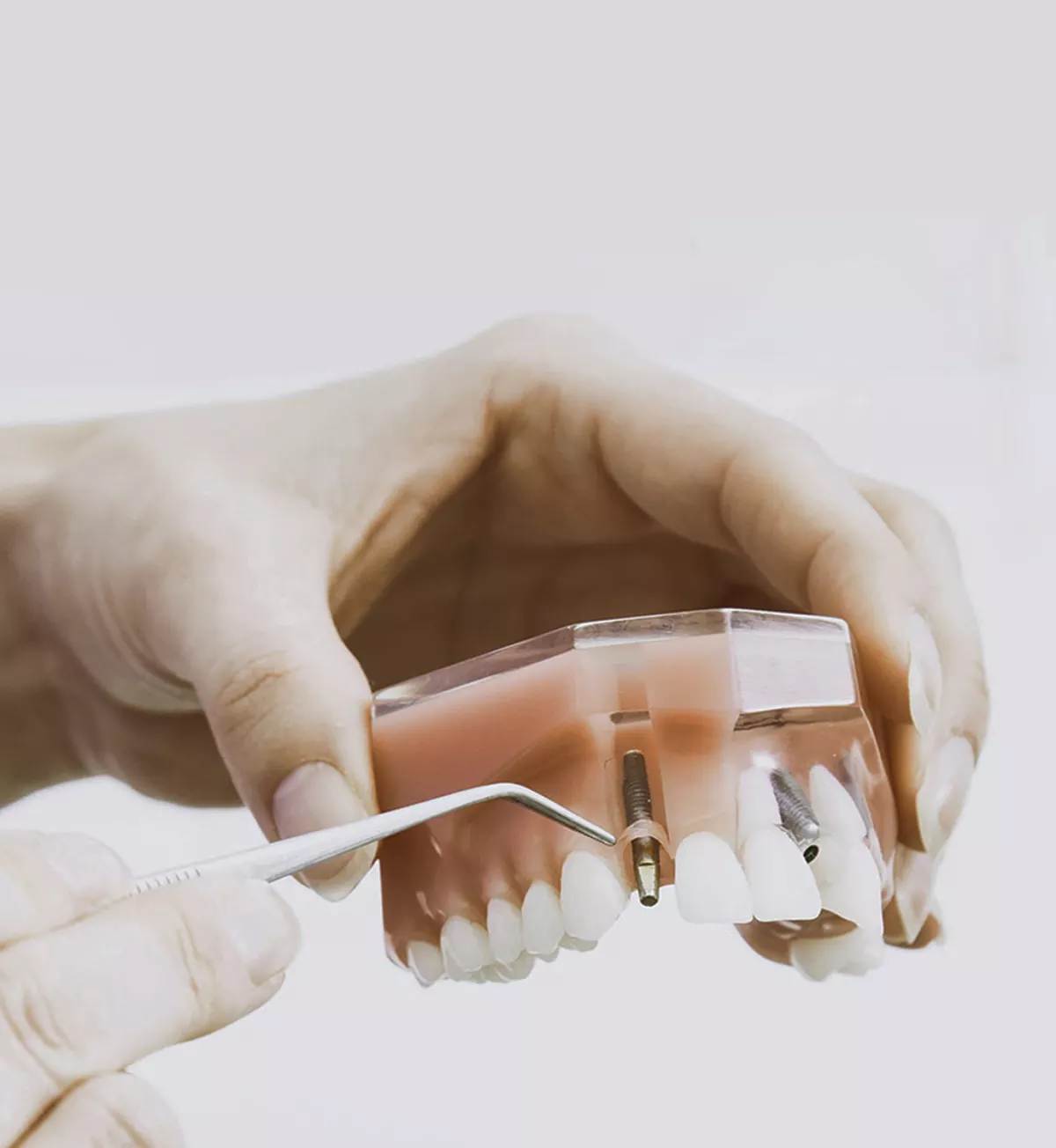 Implantes dentales con financiación en Villaverde